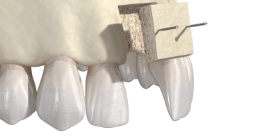 Bone Substitutes In Implantology: A Review cover