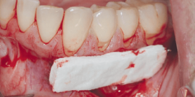 Mucograft® as an Alternative Treatment in the Management of Multiple Gingival Recessions: A Case Report cover