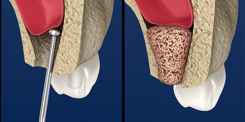 Principles, Harvesting & Healing of Bone Grafts in Dental Implant Cases cover