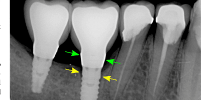 Less Screw Loosening, More Implant Success- A Recent Analysis. cover