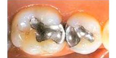 Measuring the Effect of Polymerization on Dental Composites cover