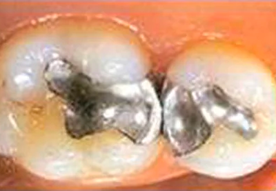 Measuring the Effect of Polymerization on Dental Composites cover