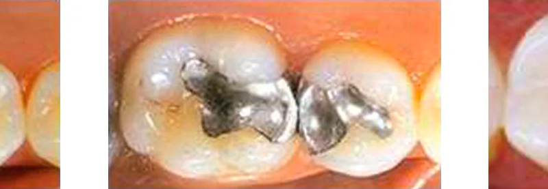 Measuring the Effect of Polymerization on Dental Composites cover