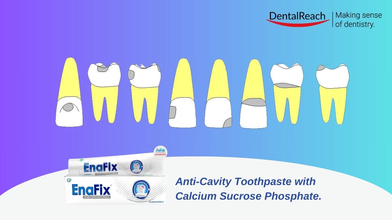 GV Black Classification: Figuring out The Foundations Of Hollow space Classification | DentalReach – Main Dental Mag