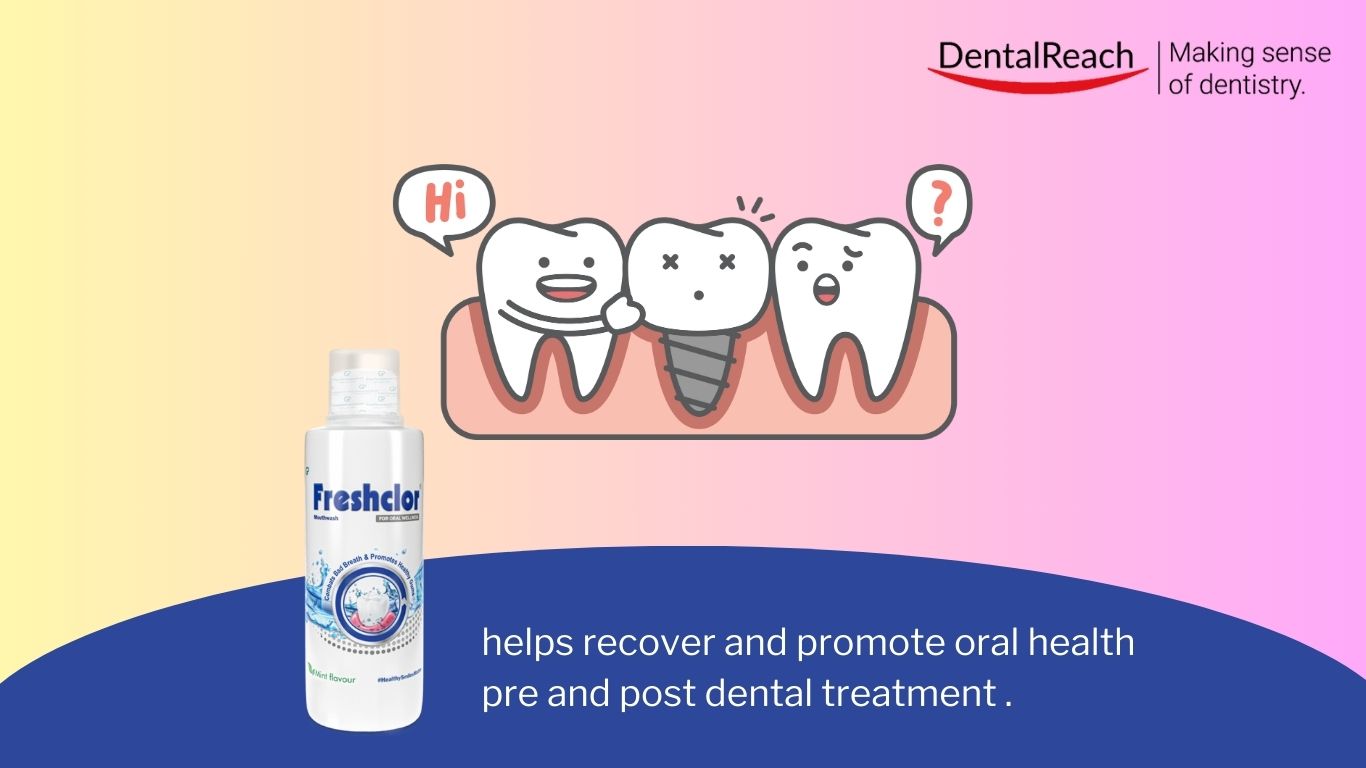 Screw-Retained Vs. Cemented All-Ceramic Implant-Supported Crowns: What To Select When? | DentalReach – Main Dental Mag