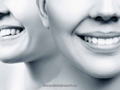 Blog 3 brace