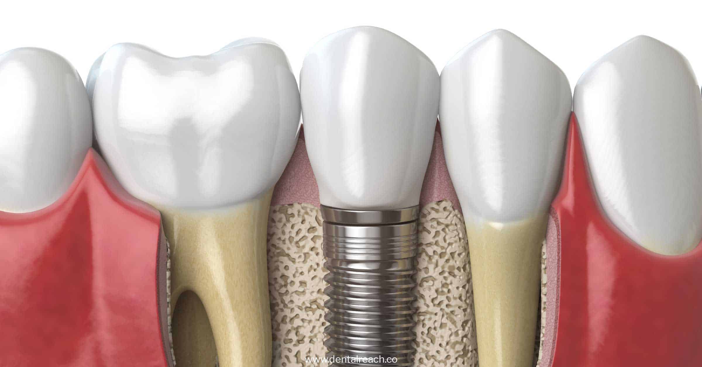 implants 1