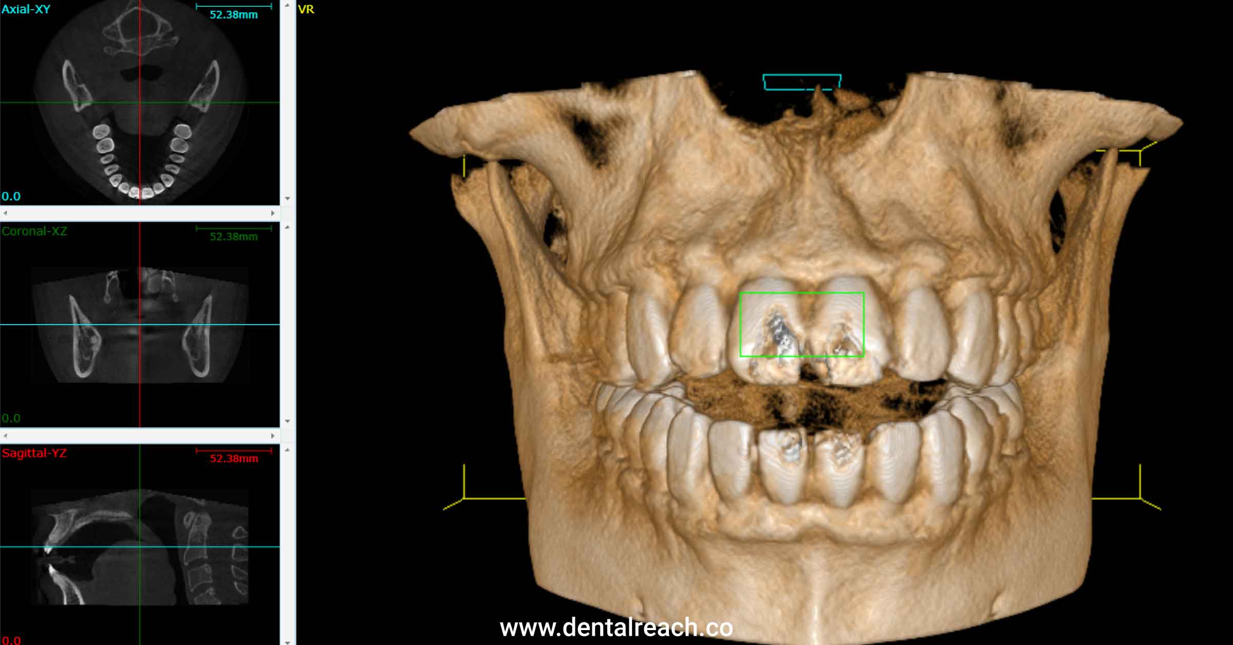 Cone Beam Computed Tomography In Endodontics | DentalReach ...