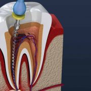 Overcoming Endodontic Failure