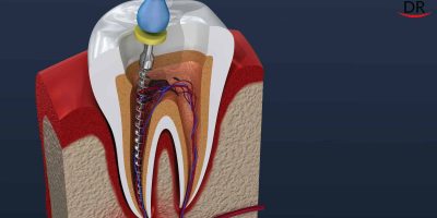 Overcoming Endodontic Failure