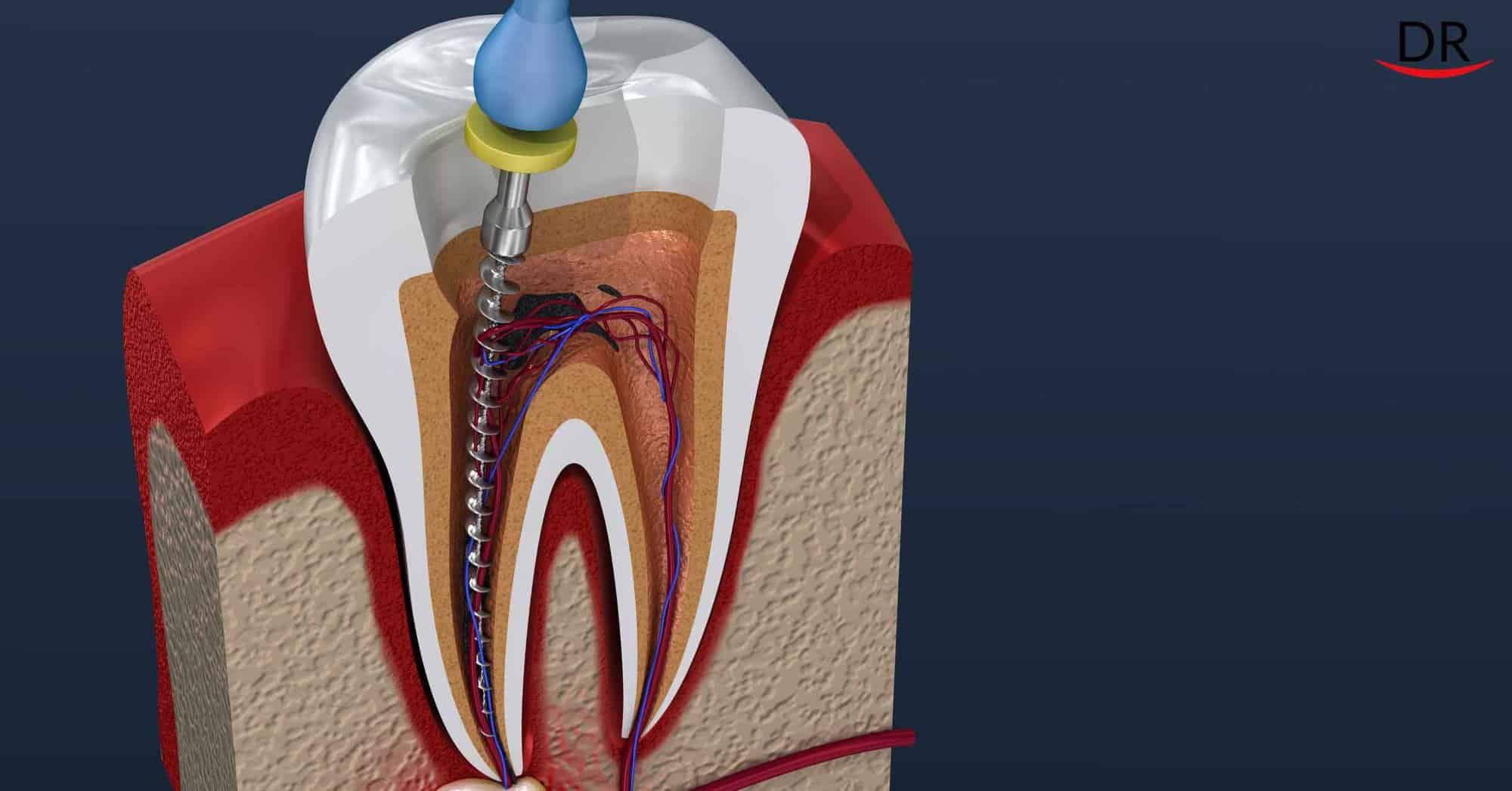 Golden Tips On Endodontic Failure Root Canal Failure