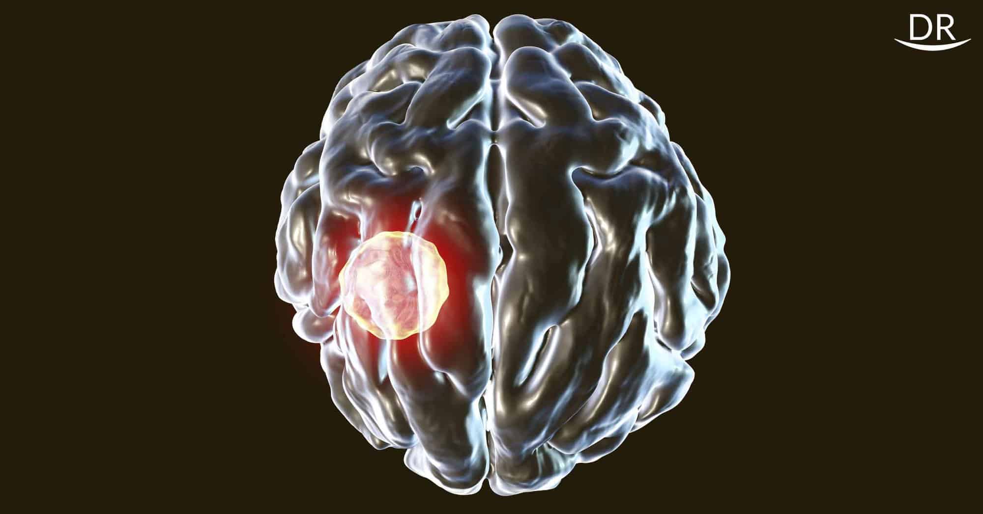 Dental Etiology: A Possible Pathway to Brain Abscesses