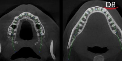 How AI 'assist' dentists to save tooth?