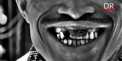 Magical Effect of Lactoferrin on Black Stained Teeth Associated with Iron Metabolism