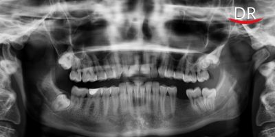 The Journey of Panoramic Radiography - A Review (Part I)