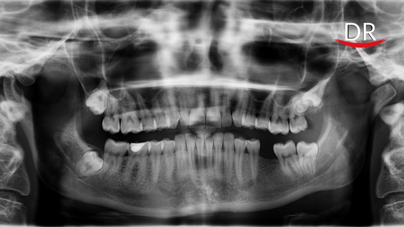 The Journey of Panoramic Radiography - A Review (Part I)