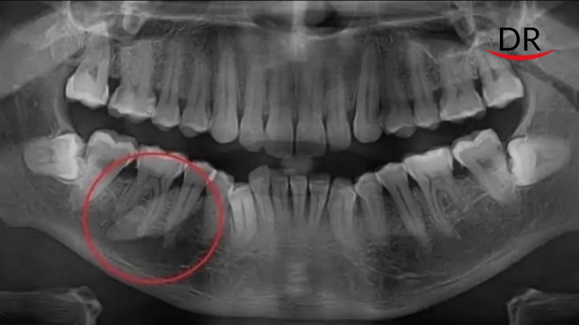 Giant Sialolith As Big As An Adult Tooth Recently Discovered From A Patient's Mouth.