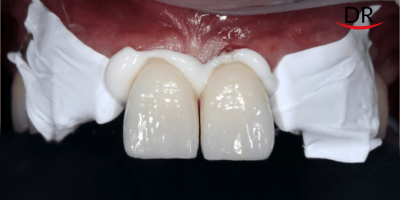 Your Go-To Guide For Cementation Of All Types Of Prosthesis (Part 1)