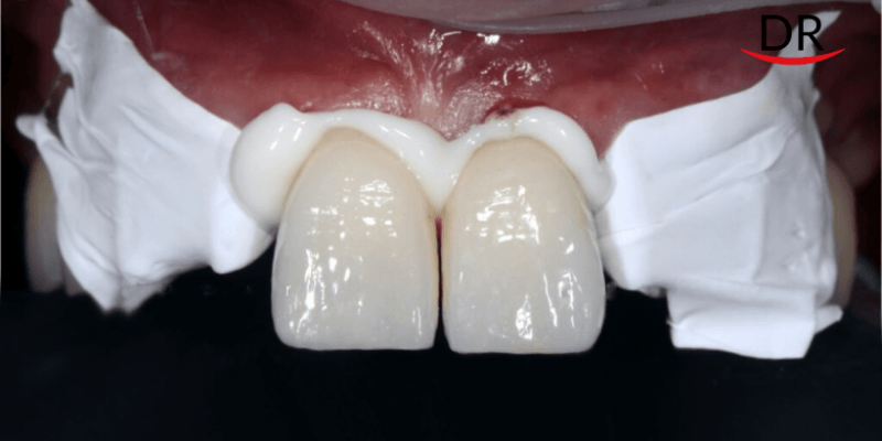 Your Go-To Guide For Cementation Of All Types Of ...