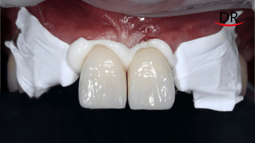 Your Go-To Guide For Cementation Of All Types Of Prosthesis (Part 1)