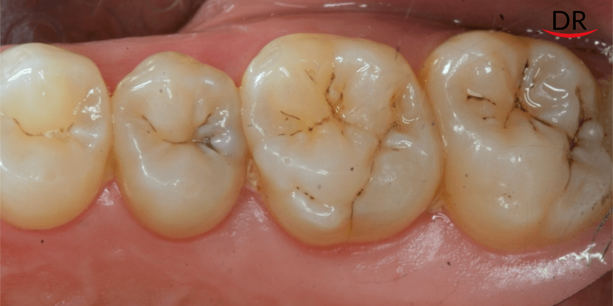 Early Detection Of Caries And Periodontal Diseases
