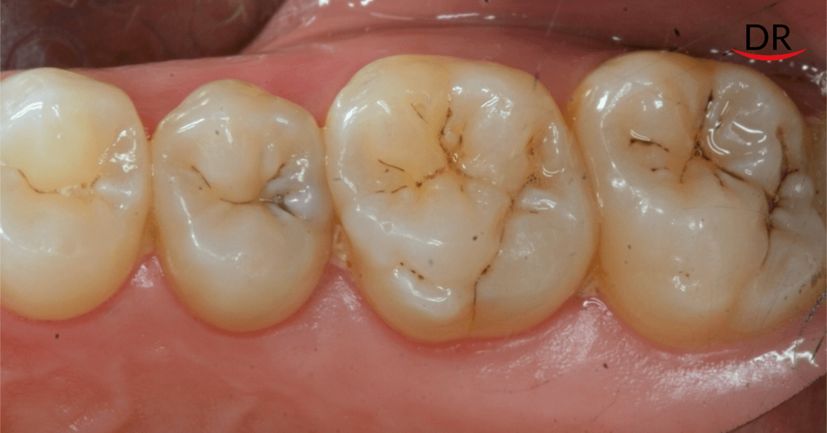 Early Detection Promises of Caries and Periodontal Diseases