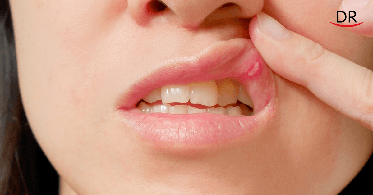Oral Lesions may be a COVID-19 Symptom, Study Suggests