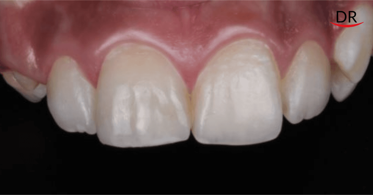 Composite Restorations for Aesthetic Correction of a Single Anterior Tooth