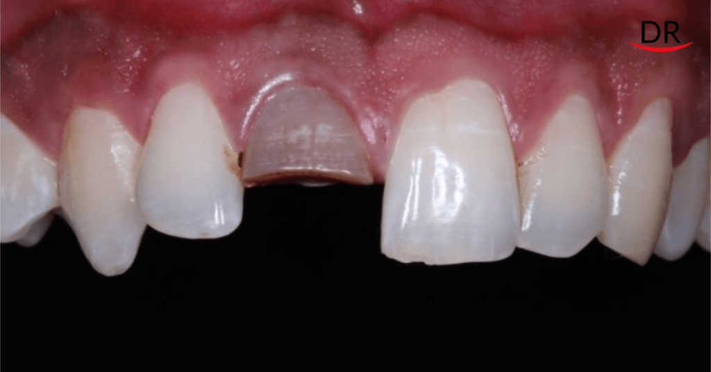 Crown Restorations for Esthetic Correction of a Single Anterior Tooth