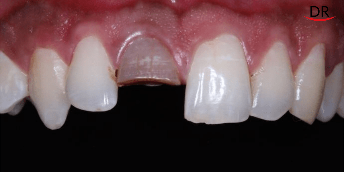 Crown Restorations For Esthetic Correction Of A Single Anterior Tooth