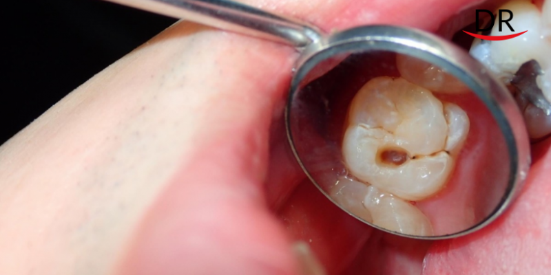 Stopping Tooth Decay Before it Starts - Cerium Oxide