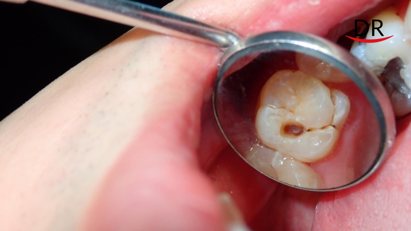 Stopping Tooth Decay Before it Starts - Cerium Oxide