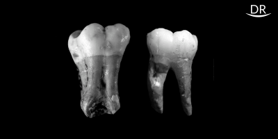 Taurodontism: A challenge to Clinical Endodontics