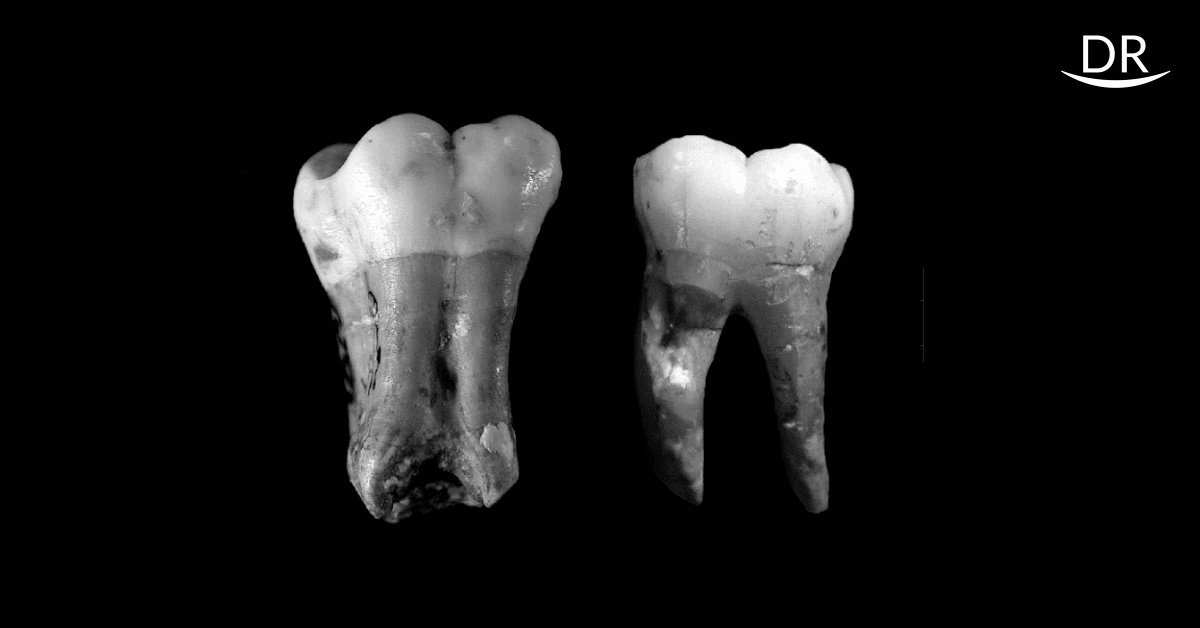 Taurodontism: A challenge to Clinical Endodontics