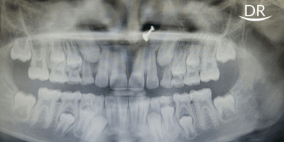 Management of Pyogenic Granuloma: A Case Report