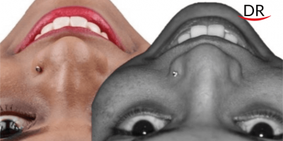 Post Orthodontic Correction of Esthetics