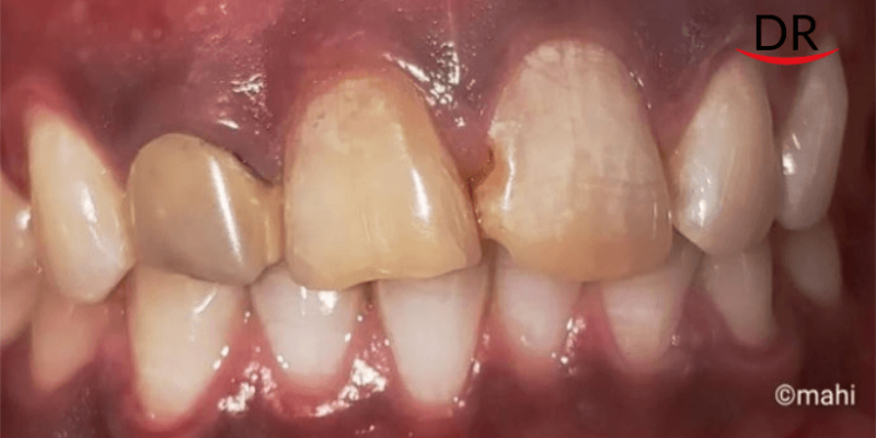 Esthetic make-over of maxillary anteriors with bleaching and layered zirconia crowns – A case report