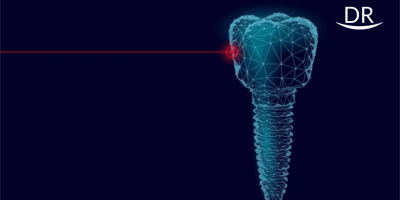 Immediate laser assisted implants placed in infected bone tissue conditioned with lasers