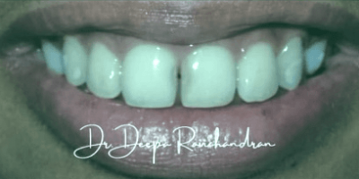 Composites Versus Crowns – Recall @ 6 months