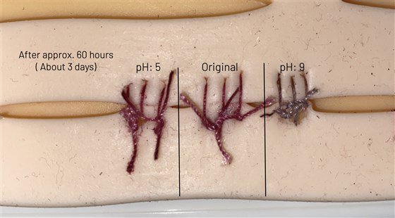 Sutures that could detect an infection-A breakthrough invention!