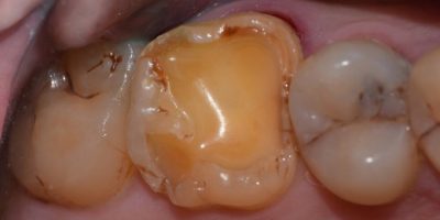 Indirect Posterior Composite Restoration: A chairside technique