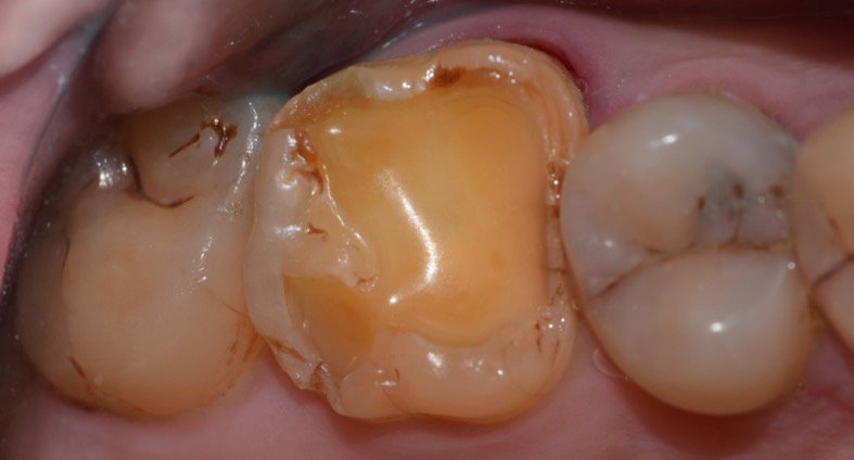 Indirect Posterior Composite Restoration: A chairside technique