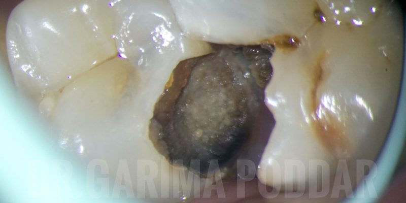 Root Canal Treatment Of Mandibular Second Premolar With 1-2 Configuration/ Type IV Weine’s Configuration- A Case Report