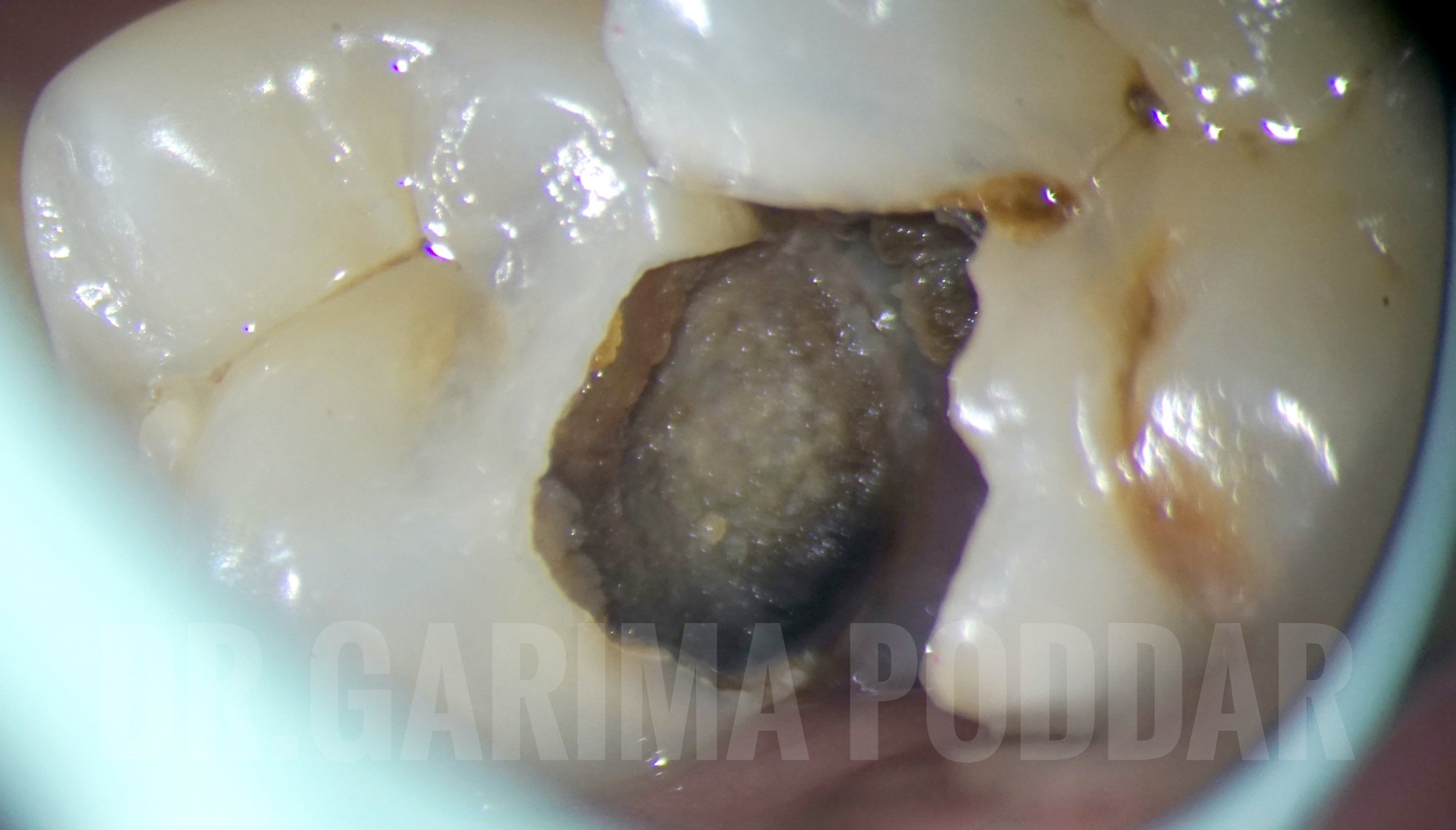 Root Canal Treatment Of Mandibular Second Premolar With 1-2 Configuration/ Type IV Weine’s Configuration- A Case Report