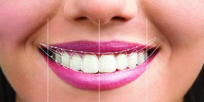 Smile Designing : Documentation To Execution