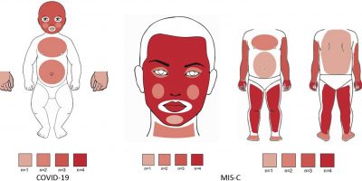Multisystem Inflammatory Syndrome in Children (MIS-C) following COVID-19 infection
