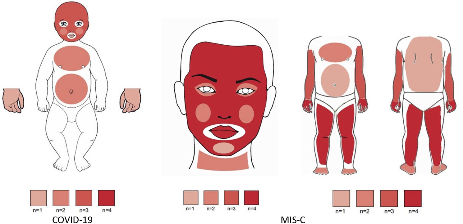 Multisystem Inflammatory Syndrome in Children (MIS-C) following COVID-19 infection