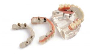 PEEK: A Prodigious Material in Dentistry