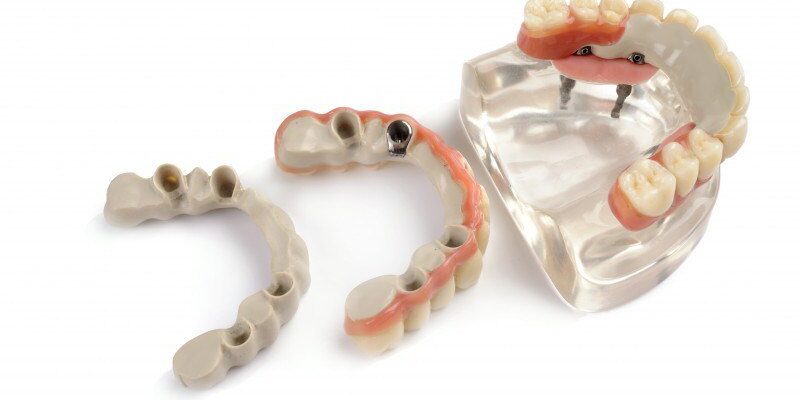 PEEK: A Prodigious Material in Dentistry