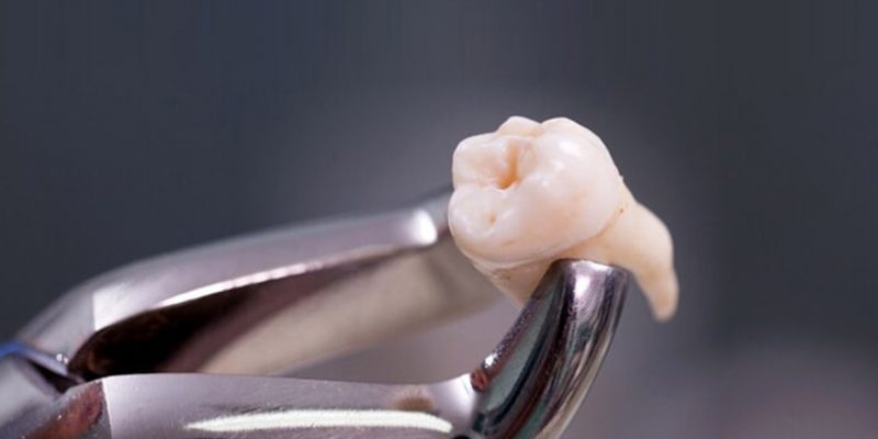 Wisdom Teeth Extraction Can Actually Improve Your Taste, Finds Study